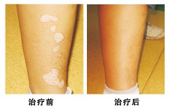 白癜风的罪魁祸首竟是这些原因?(图1)