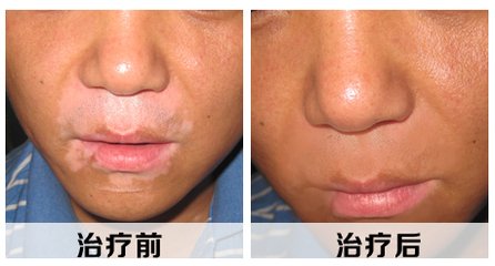 白癜风患者该怎样做好护理呢?(图1)