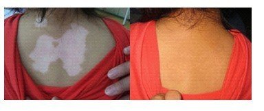 女性白癜风是怎么患上的呢？(图1)