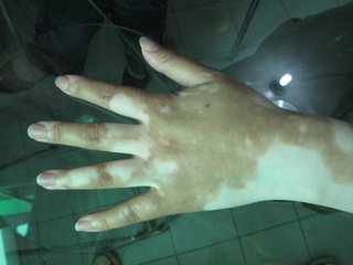如何预防白癜风的发生?(图1)