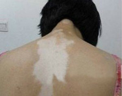 夏季预防白癜风三种方法别错过(图1)