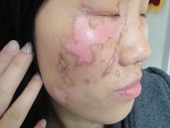 白癜风的严重程度可以通过什么去判断?(图1)