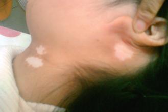 儿童白癜风要去哪里治疗?(图1)