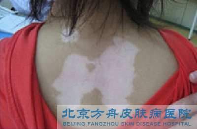 白癜风是由什么引起的呢(图1)