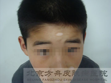 小孩脸上有白斑是怎么回事(图1)