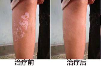 男性白癜风的病因是什么(图1)