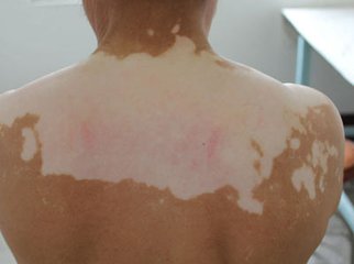 如何调节白癜风患者的心理问题?(图1)