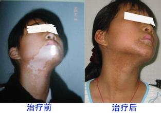 白癫风有几大类型?(图1)