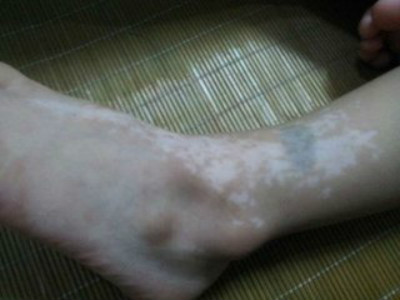 有哪些常见预防白癜风的方法?(图1)
