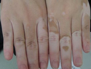 手部白癜风的患病原因是什么?(图1)
