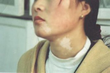 治疗白癜风是要注意什么?(图1)