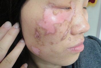 面部白癜风有哪些症状?(图1)