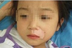 白癜风的发生对儿童患者有心理影响吗(图1) 白癜风的发生对儿童患者有心理影响吗(图1)