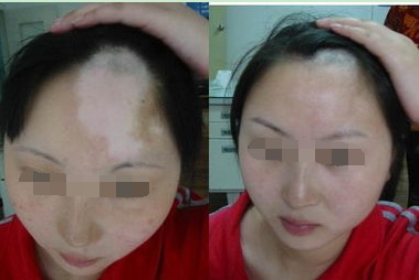 孕妇患白癜风后应怎么治疗(图1)