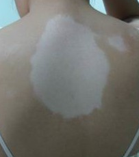 青春期白癜风的预防方法(图1)