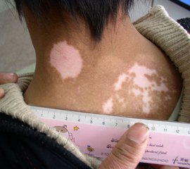 生活中白癜风治疗的误区(图1)