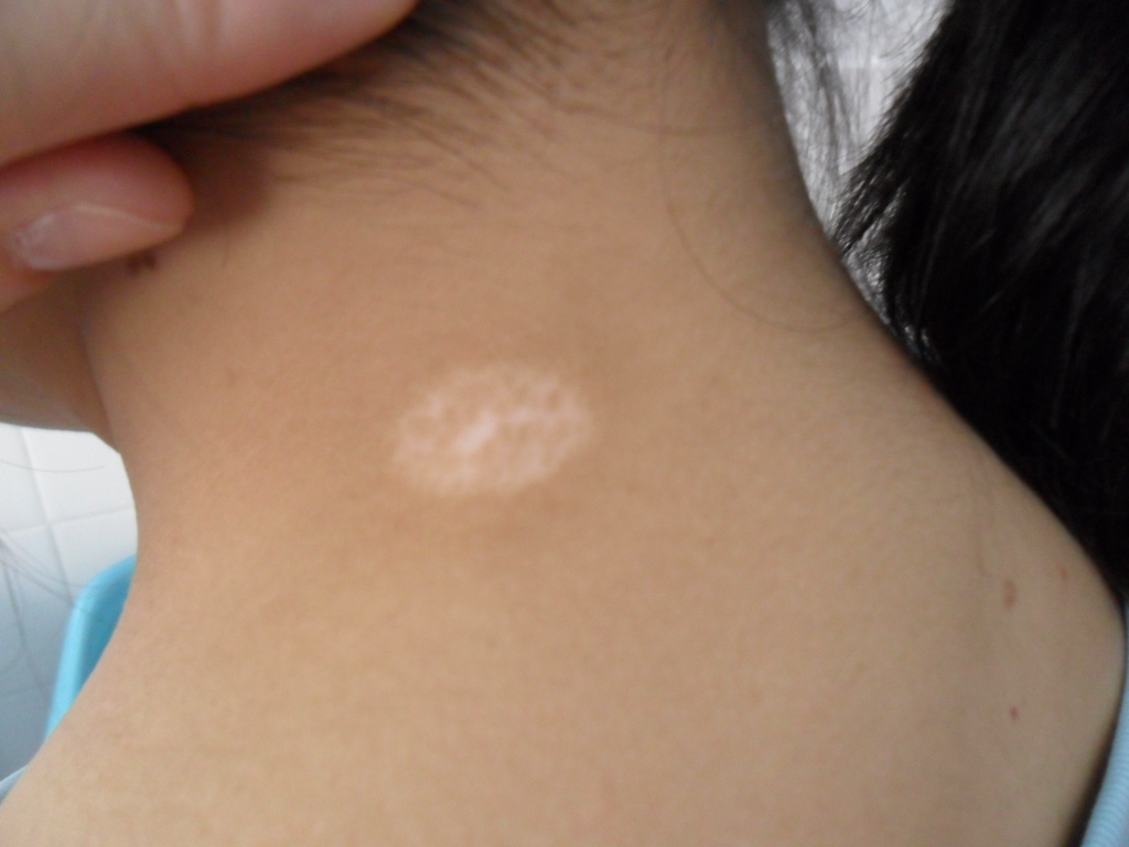 为什么小孩子患有白癜风误诊率会比成年人高(图1)