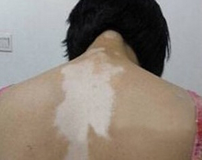 儿童得了局限型白癜风怎么做(图1)