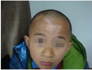 为什么儿童白癜风患者不能盲目用药(图1)