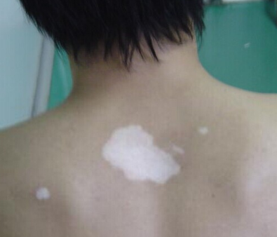 儿童白癜风的预防措施有哪些(图1)