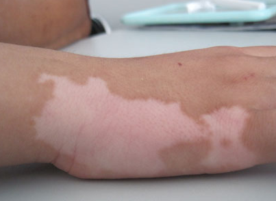 儿童白癜风的饮食有什么要求(图1)