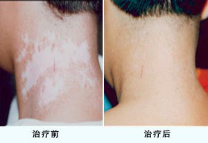 白癜风治疗时容易出现哪些误区呢(图1)