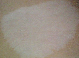 白癜风的复发率到底有多高(图1)