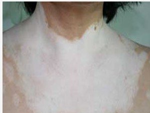 白癜风的发展期要怎么鉴别(图1)