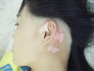 白癜风如何治疗和控制疾病进一步的发展呢(图1)