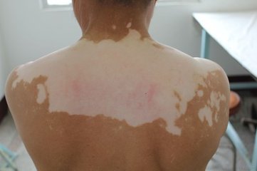 平时需要怎样预防白癜风?(图1)