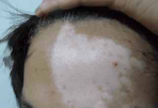 白癜风的早期症状都有哪些(图1)