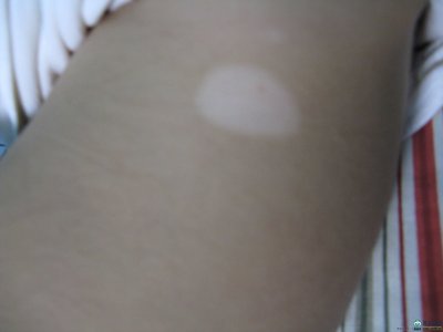 白癜风患者日常该如何护理呢(图1)