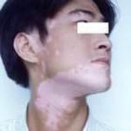控制白癜风扩散的小妙招有哪些?(图1)