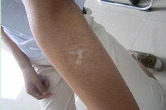 白癜风患者能不能化妆?(图1)